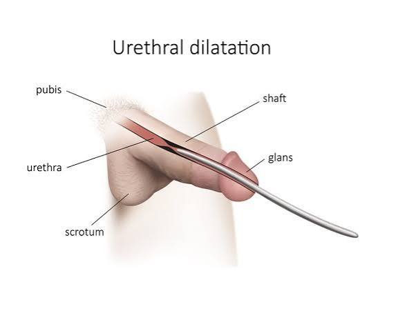 Endocystolithotripsy for bladder stones